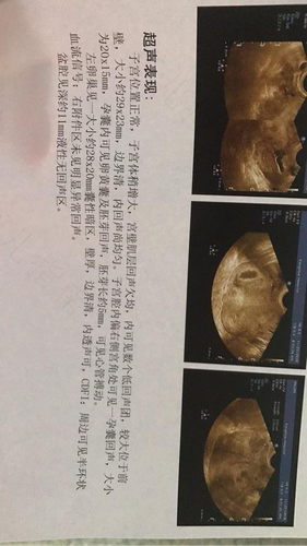 子宫偏左是什么原因引起的