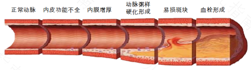 动脉硬化症状有哪些 动脉硬化症状有哪些