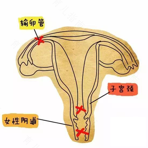 细菌性阴炎会导致不孕不育吗 细菌性阴炎会导致不孕不育吗