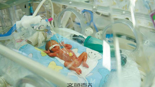 孕中期龙凤胎流产 胎膜早破孕妇渐增多 孕中期龙凤胎流产 胎膜早破孕妇渐增多