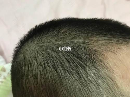 鬓角痒脱皮怎么回事 鬓角痒脱皮怎么回事