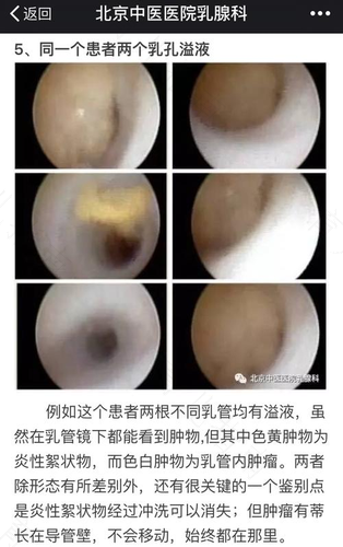 乳头溢液需要治疗吗 乳头溢液需要治疗吗