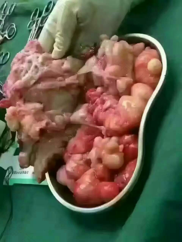 子宫肌瘤会变小消失吗 子宫肌瘤会变小消失吗