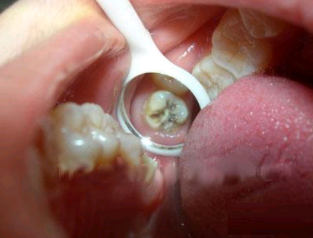 虫牙疼怎么办最快最有效 虫牙疼怎么办最快最有效