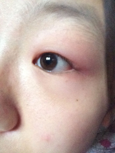 眼睛肿是怎么回事儿 眼睛肿是怎么回事儿