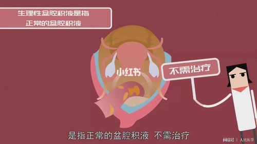 盆腔腹水怎么治疗最好最快 盆腔腹水怎么治疗最好最快