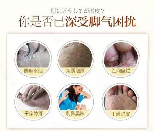 脚气怎么根治用什么药 脚气怎么根治用什么药
