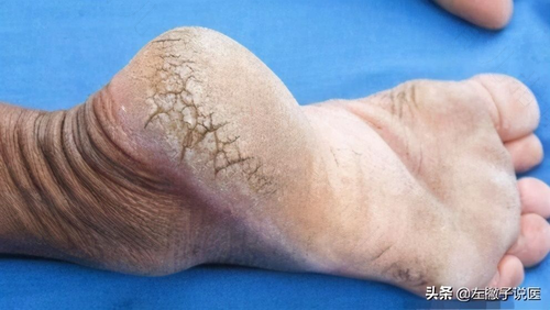 女人脚后跟干裂起硬皮怎么办 女人脚后跟干裂起硬皮怎么办