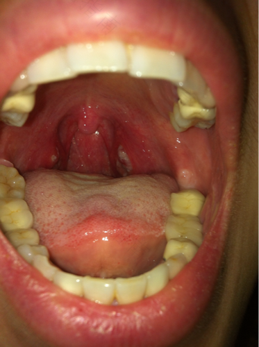 咽喉脓肿化脓怎么办 咽喉脓肿化脓怎么办