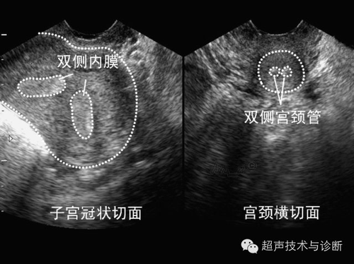 什么是纵隔子宫 什么是纵隔子宫