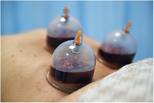 哮喘可以拔罐吗