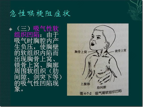 喉头梗阻的常见原因都有哪些 喉头梗阻的常见原因都有哪些