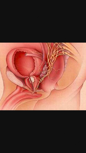 怎么知道尿路感染好了没 怎么知道尿路感染好了没