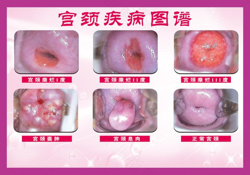 拟诊宫颈病变是什么意思 拟诊宫颈病变是什么意思