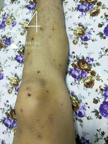 湿疹久治不愈会癌变吗 湿疹久治不愈会癌变吗