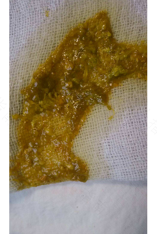 婴儿大便水分多是怎么回事 婴儿大便水分多是怎么回事