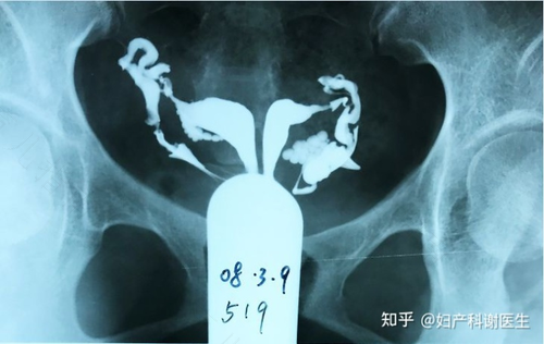 子宫造影检查后需要注意什么 子宫造影检查后需要注意什么