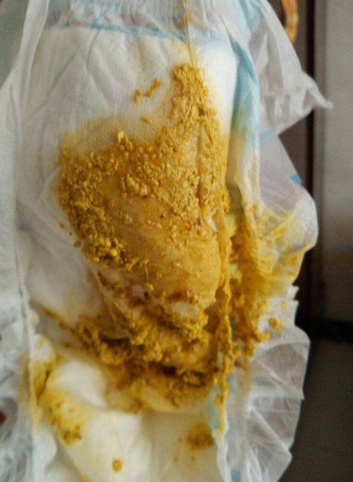 拉肚子后胃胀气怎么办 拉肚子后胃胀气怎么办