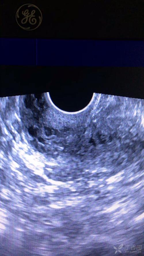 乳腺呈蜂窝状是什么意思