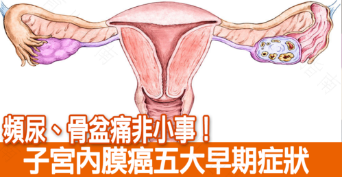 子宫左侧有点隐隐作痛是怎么了 子宫左侧有点隐隐作痛是怎么了