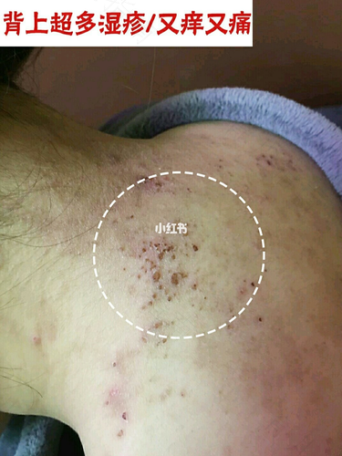 晚上痒的睡不着 晚上痒的睡不着