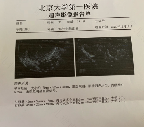 多囊卵巢和卵巢囊肿是一种病吗 多囊卵巢和卵巢囊肿是一种病吗