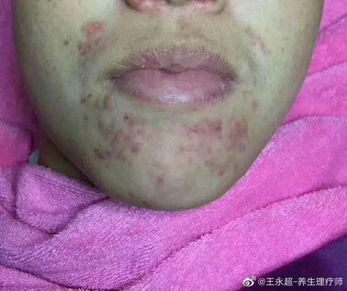 外阴长了个黄豆大的硬疙瘩 外阴长了个黄豆大的硬疙瘩