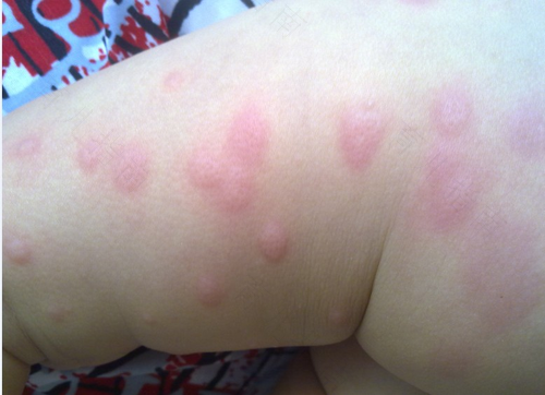 怀孕起荨麻疹对胎儿有影响吗 怀孕起荨麻疹对胎儿有影响吗