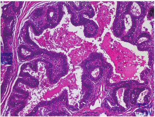 乳腺水泡囊肿怎么治疗 乳腺水泡囊肿怎么治疗