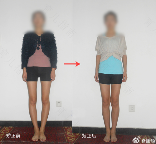 O型腿如何矫正?