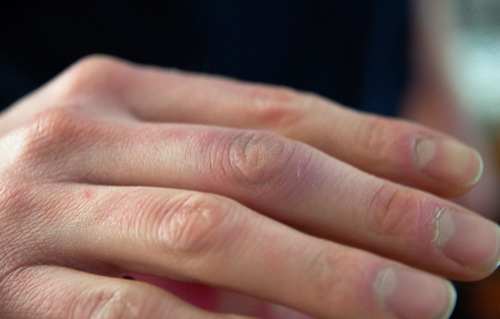 五个手指关节痛是怎么回事 五个手指关节痛是怎么回事