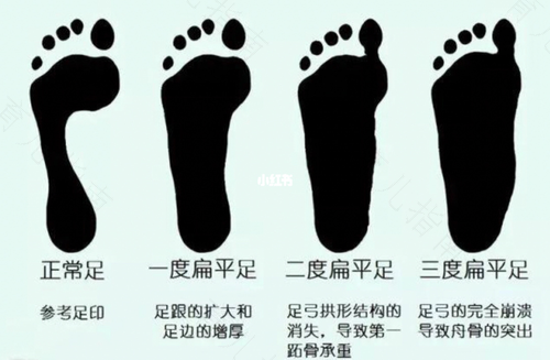 扁平足的好处和坏处