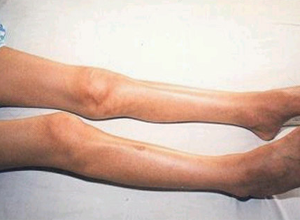 肌肉无力怎么办? 肌肉无力怎么办?