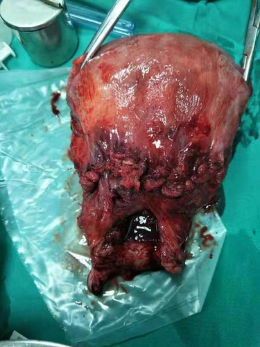 宫颈糜烂手术后出血正常吗 宫颈糜烂手术后出血正常吗