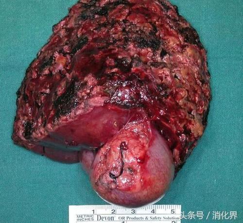 胆囊息肉怎么形成的原因 胆囊息肉怎么形成的原因