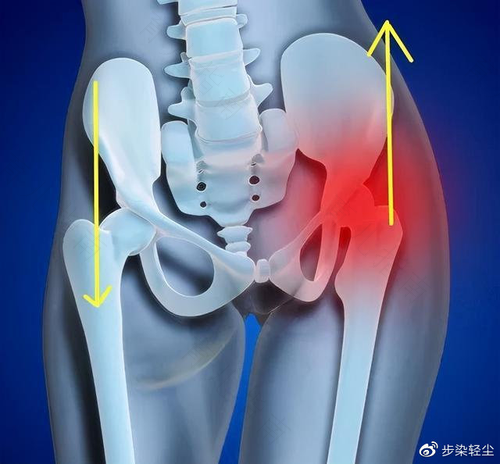 骨盆倾斜做什么检查确诊 骨盆倾斜做什么检查确诊