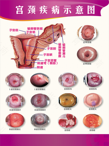 子宫囊肿有什么症状 子宫囊肿有什么症状