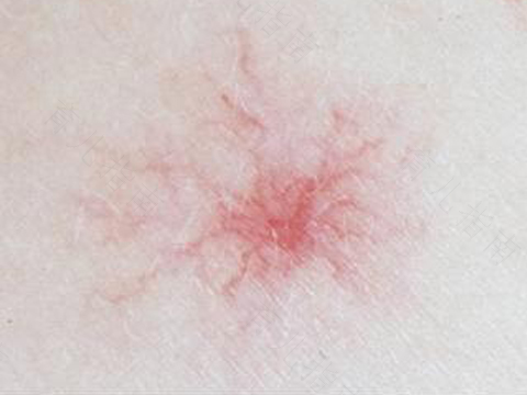 胎记长毛可以去掉吗 胎记长毛可以去掉吗