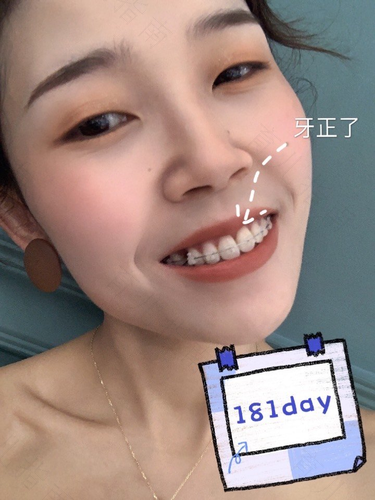 30岁还可以矫正牙齿吗? 30岁还可以矫正牙齿吗?