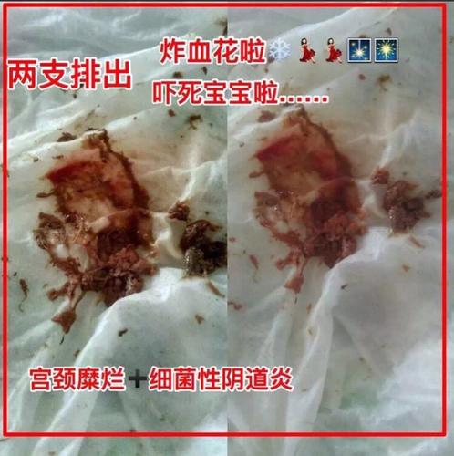 子宫上长泡泡是什么 子宫上长泡泡是什么