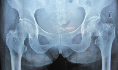 怀孕股骨头疼怎么回事 怀孕股骨头疼怎么回事