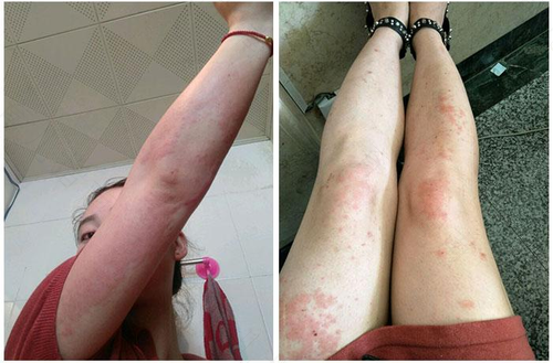 过敏性体质会遗传吗 过敏性体质会遗传吗