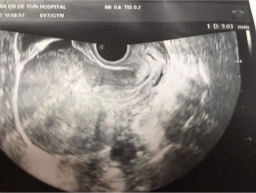 子宫内膜息肉b超显示什么