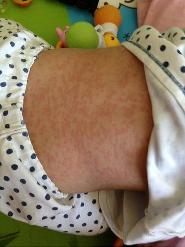 风疹怎么样确定是好了 风疹怎么样确定是好了