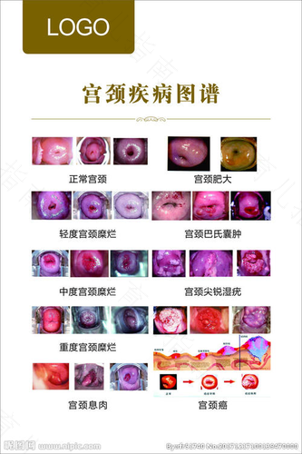 宫颈低级病变会发展吗? 宫颈低级病变会发展吗?