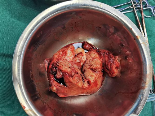 子宫全切会影响 子宫全切会影响