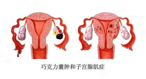 子宫容易得哪些疾病 子宫容易得哪些疾病