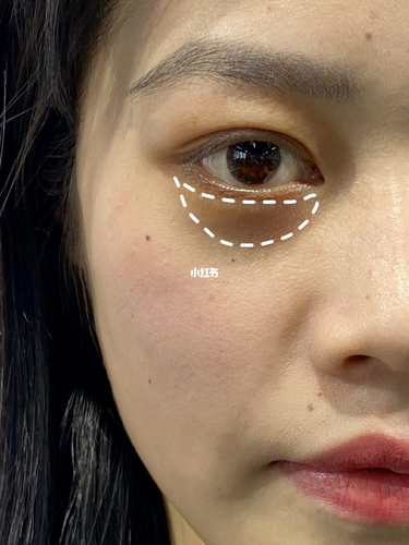 眼下边发黑是怎么回事 眼下边发黑是怎么回事