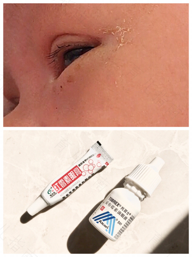 泪囊炎通了是什么样子 泪囊炎通了是什么样子