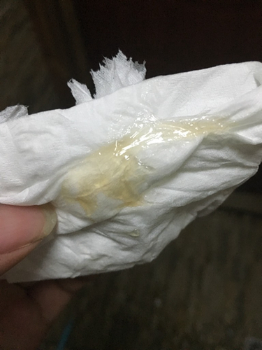 白带有血丝是怎么回事拉大便 白带有血丝是怎么回事拉大便